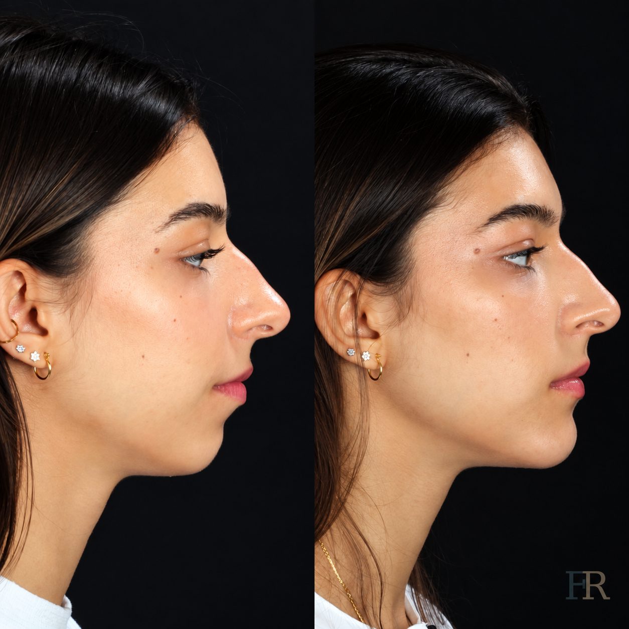 Chin implant · Clinical record