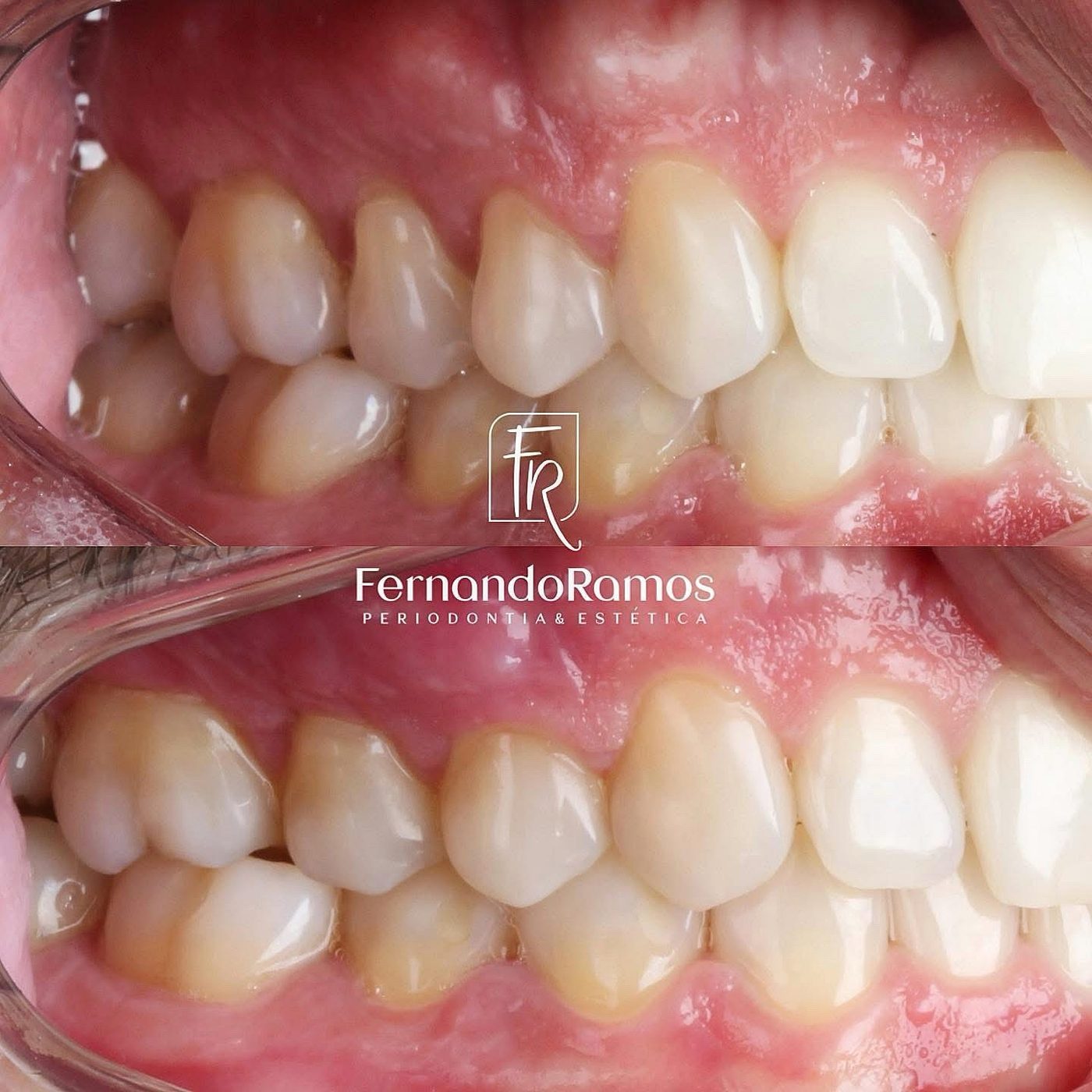 Gum grafts · Clinical record
