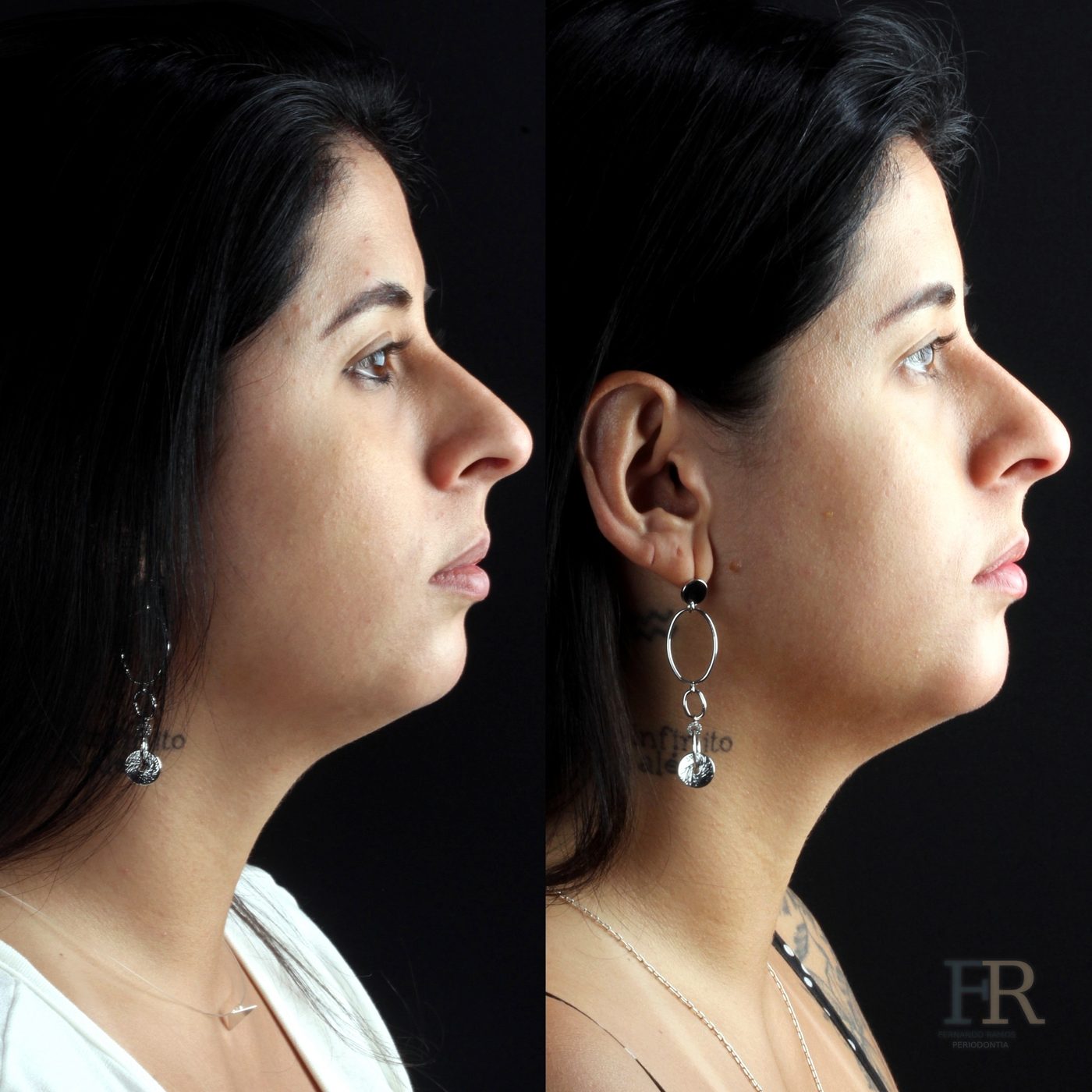 Chin implant · Clinical record