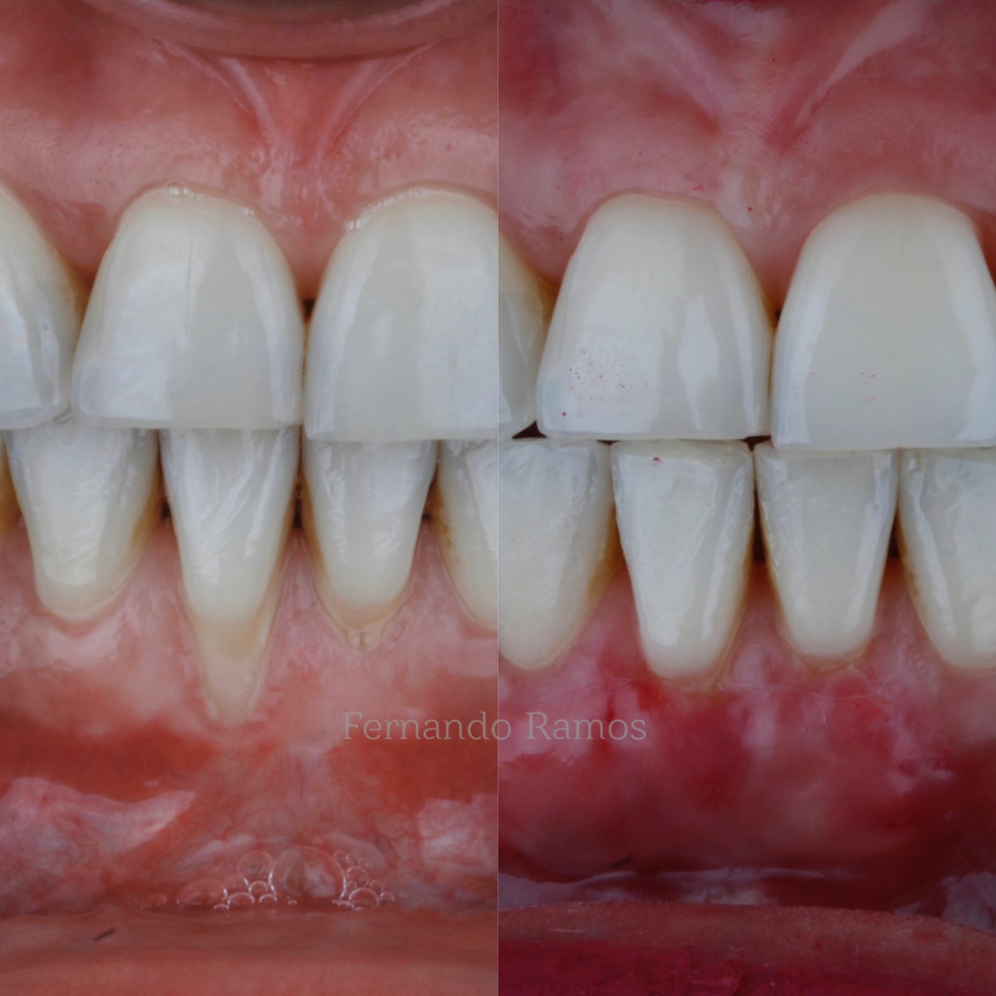 Gum grafts · Clinical record