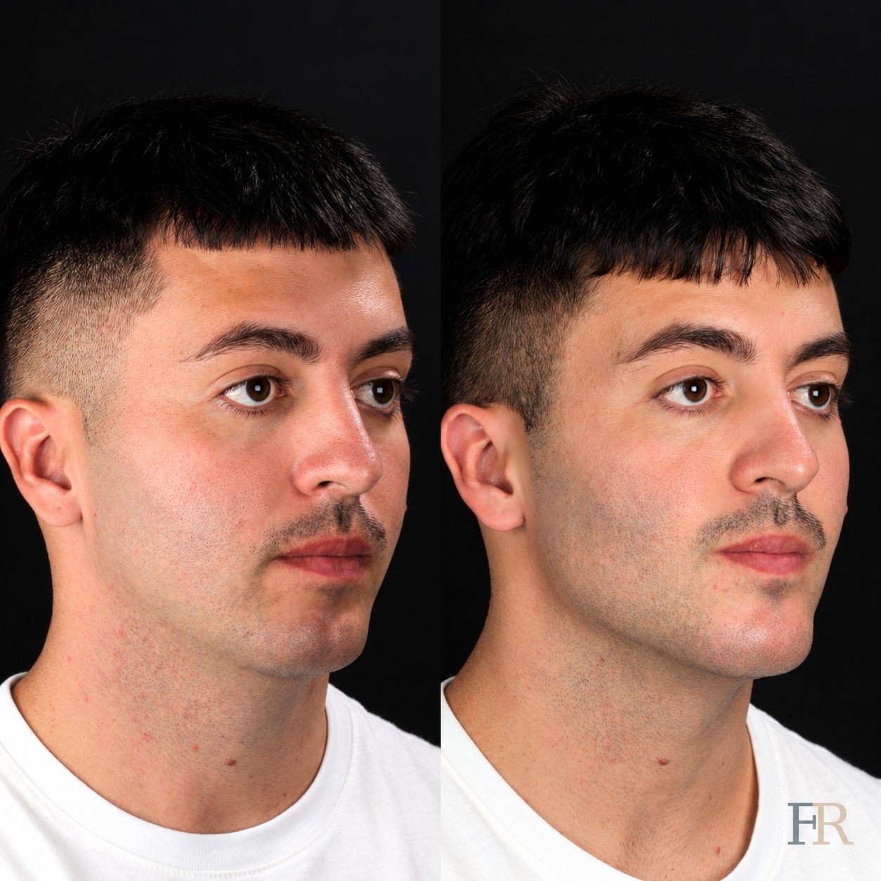Jaw angle implant · Clinical record
