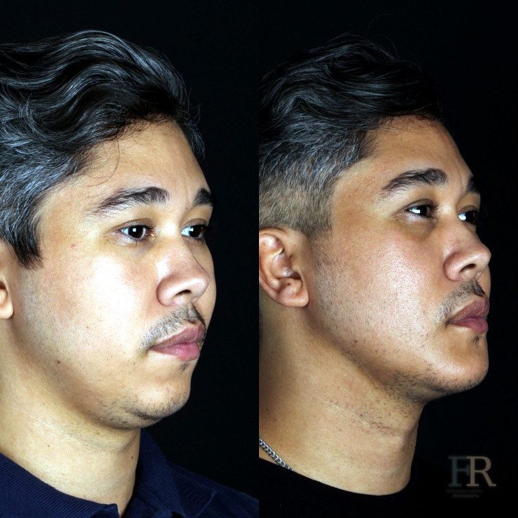 Jaw angle implant · Clinical record