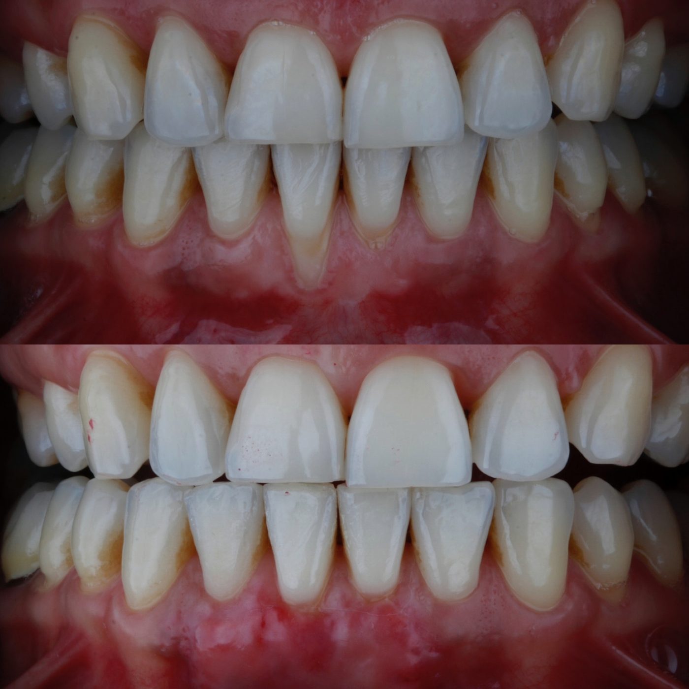 Gum grafts · Clinical record