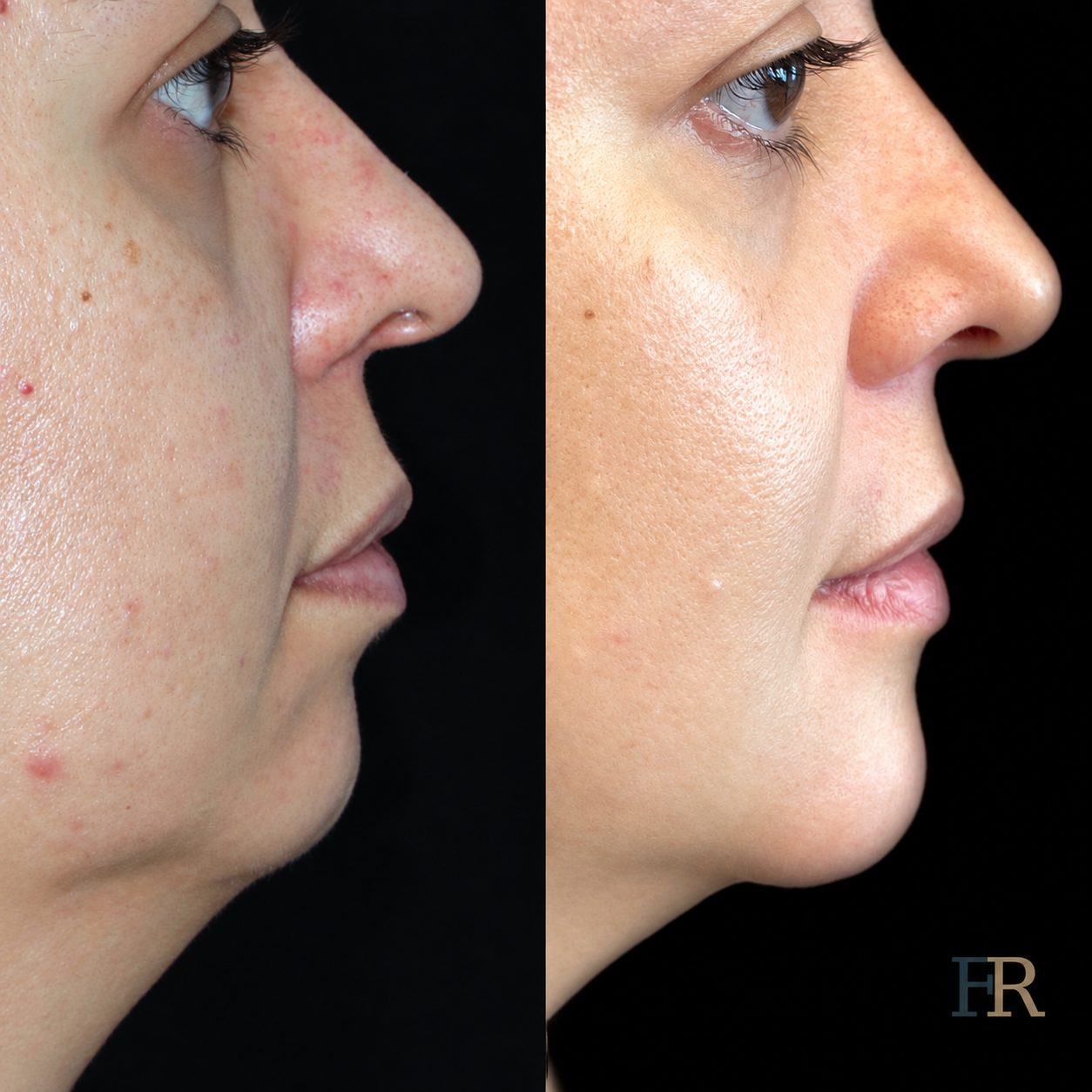 Chin implant · Clinical record