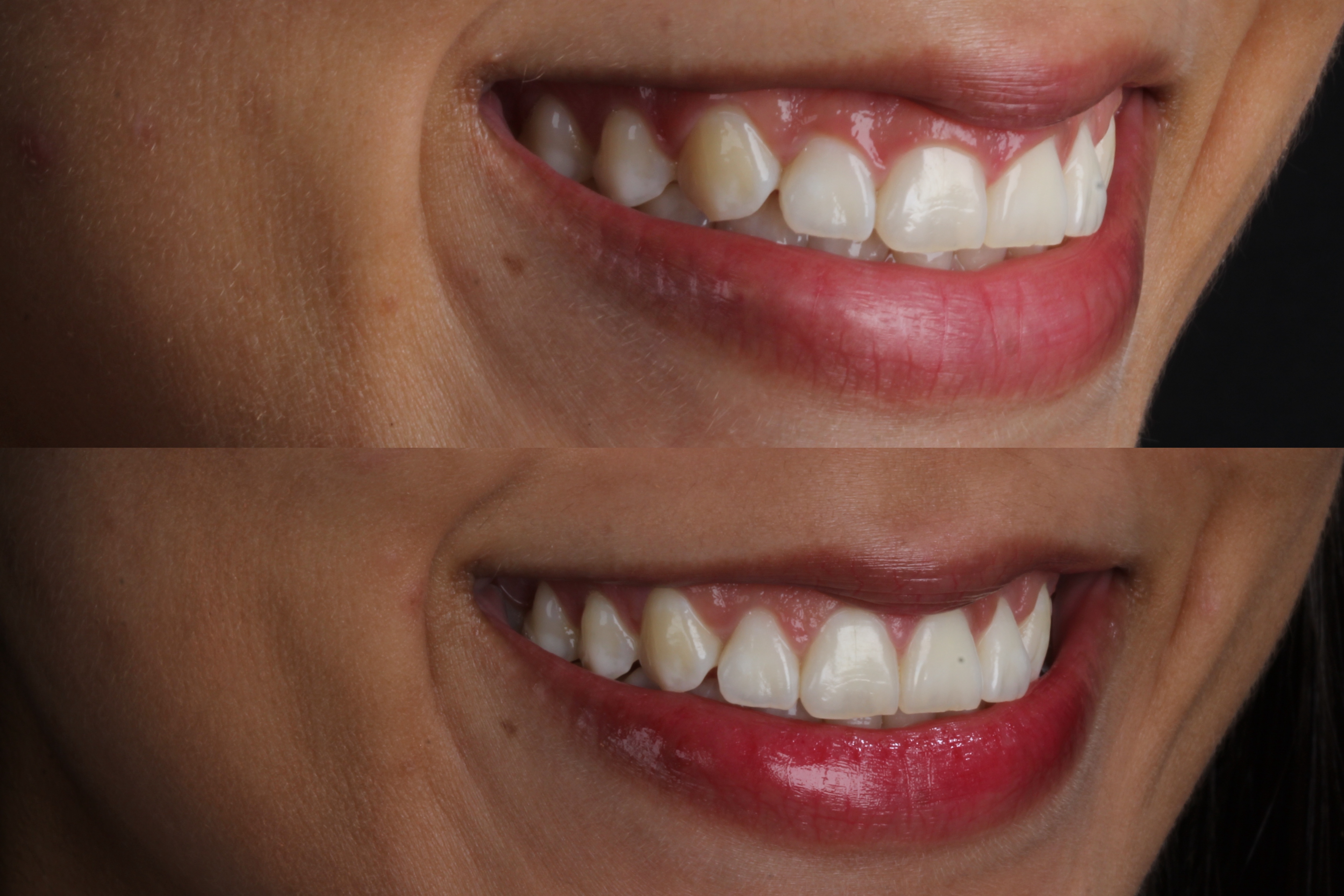 Cirurgia periodontal · Comparação do sorriso
